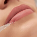 Preenchimento Labial: Reconquiste a sua Autoconfiança